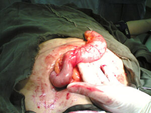 Huge mucocele of the appendix