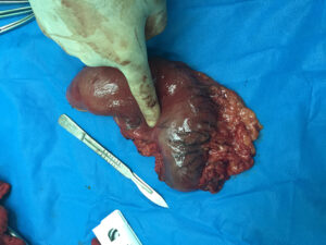 Partial distal gastrectomy for gastric carcinoma