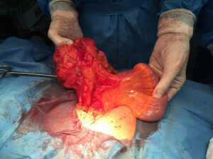 Extended right hemicolectomy for carcinoma of ascending colon