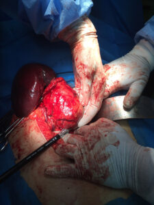 Distal pancreatectomy and splenectomy for pancreatic body and tail tumour