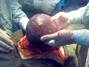 Splenic torsion-wondering spleen