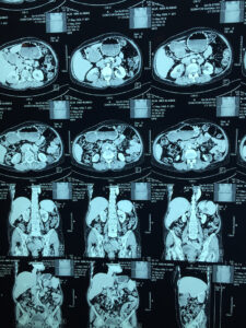 Distal pancreatectomy and splenectomy for pancreatic tail carcinoma