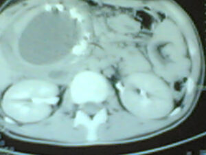 Pancreatic pseudocyst in the region of the pancreatic head