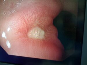 Active prepyloric ulcer (endoscopic view)