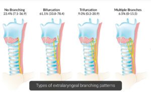 BRANCHING RLN finding during total thyroidectomy (June.2022)