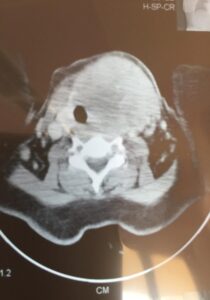 Chylous fistula after total thyroidectomy and radical lymph node dissection for anaplastic thyroid carcinoma ( Nov. 2016)