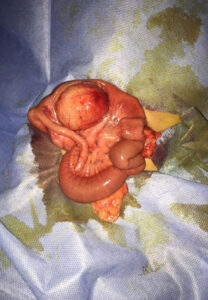 Enteric duplication cyst (Jan. 2017)