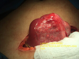 Resection of large hepatic FNH in young adult female