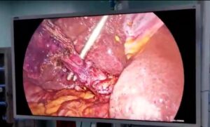 Fundus First Laparoscopic Cholecystectomy 3 ports (Sep.2020)