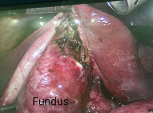 Fundus-first approach for difficult laparoscopic cholecystectomy