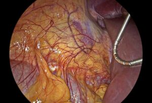 Laparoscopic Adrenalectomy – Report of two cases (Feb.2020)