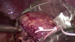 Laparoscopic Splenectomy for Wandering spleen with chronic torsion in 16 year old female (Jan.2021)