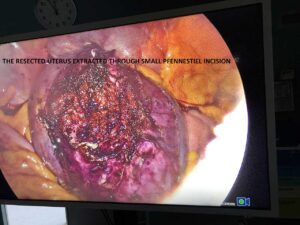 Laparoscopic Supracervical Abdominal Hysterectomy LSH for large uterine MYOMA (Mar.2020)