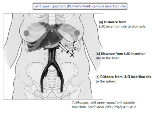 Laparoscopic abdominal access (Mar. 2017)