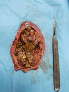 Laparoscopic cholecystectomy for Gallbladder carcinoma confined to the gallbladder (Nov. 2020)