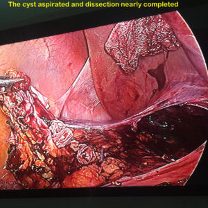 Laparoscopic management of Adrenal Pseudocyst (Nov. 2017)