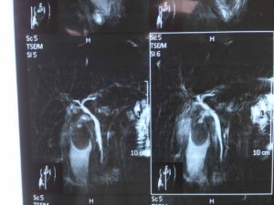 Large Gallstone Removed Laparoscopically (May.2020)