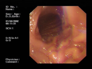 Large gastric hyperplastic polyp in site of surgical gasteroenterostomy (Mar. 2018)