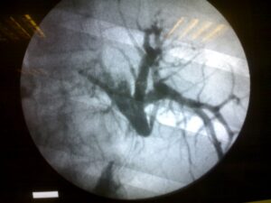 Postcholecystectomy major CBD injury