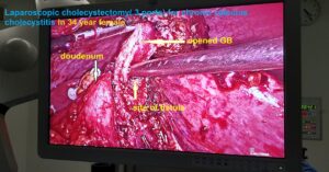 Management of Cholecysto-Doudenal fistula during Laparoscopic Cholecystectomy (Nov.2019)