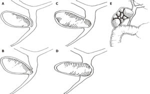 Mirrizi type I Difficult Laparoscopic Cholecystectomy (June 2018)