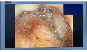 OGD = CHRONIC DUODENAL ULCER WITH PYLORIC STENOSIS (APRIL. 2021)