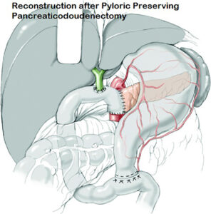 Pyloric Preserving Pancreaticodoudenectomy (Whipple procedure) (OCT. 2017)