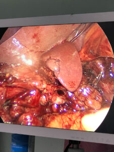 RIEDLE’S LOBE ENCOUNTERED DURING FUNDUS FIRST LAPAROSCOPIC CHOLECYSTECTOMY (SEP.2021)