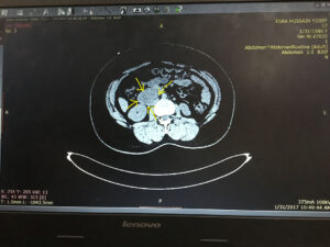 Retroperitoneal Non Functioning Paraganglioma Simulating A Pancreatic Mass (April. 2017)