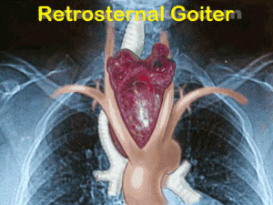 Retrosternal Goiter (June 2017)