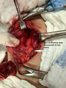 Retrothyroidal intramuscular haemangioma (Feb.2019)