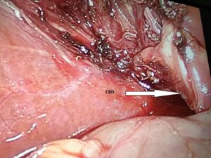 Right Posterior Aberrant Sectoral Duct identified during Laparoscopic Cholecystectomy (Des.2019)