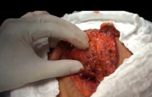 1SUPERFICIAL PAROTIDECTOMY FOR RIGHT PAROTID PLEOMORPHIC ADENOMA (NOV. 2021)