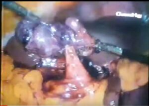 Succesfull laparoscopic treatment of cholecystoduodenal fistula (April 2018)