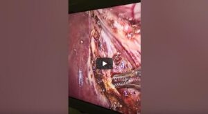 Subvesical duct of Lushka encountered during laparoscopic cholecystectomy (Oct.2019)