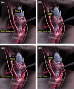 Sixth case of NON RLN encountered during total thyroidectomy (Aug.2020)