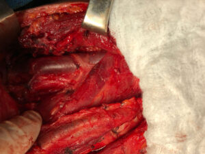 THYROID CRCINOMA=TOTAL THYROIDECTOMY AND LEFT CERVICAL LNs DISSECTION (APRIL.2022)