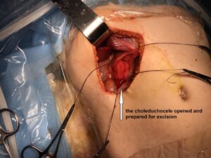 Choleduchocele (Type 3B choleduchal cyst) masquerading as Duodenal duplication cyst (June 2019)