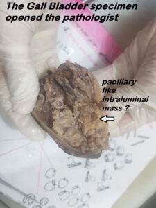 Unusual presentation of type IV Choledochal cyst in 8 years old boy (Des. 2018)