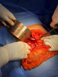 Whipple’s pancreaticoduodenectomy for early ampullary carcinoma (July.2022)