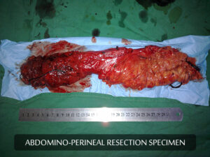 Leiomyosarcoma of the rectum