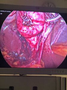 Anterior cystic artery encountered during laparoscopic cholecystectomy (JAN.2022)