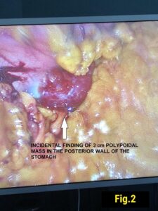 THE INCIDENTAL FINDING OF GASTROINTESTINAL STROMAL TUMOR IN PATIENT UNDERGOING LAPAROSCOPIC SLEEVE GASTRECTOMY (Aug.2019)