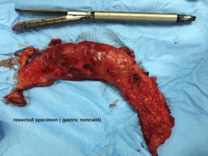 LAPAROSCOPIC SLEEVE GASTRECTOMY AS A REVISION FOR A FAILED LAPAROSCOPIC GASTRIC PLICATION (July 2019)