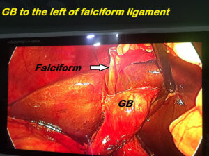 Laparoscopic Cholecystectomy for Left Sided GB without Situs Inversus (Nov. 2018)