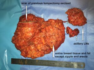 Nipple Sparing Mastectomy with Primary Implant plus auxiliary dissection (Sep. 2019)