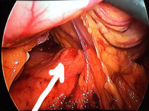 Laparoscopic enucleation of solitary pancreatic insulinoma in Al Najaf City in Iraq (Sep.2017)