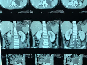 laparoscopic left adrenalectomy (Aug.2022)