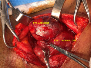 FOUR CASES OF PARATHYROID ADENOMAS PRESENTED IN THE SAME MONTH!!! AND OPERATED SEQUENTIALLY (April.2019)