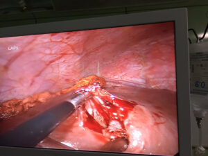 Laparoscopic removal of liver hydatid cyst